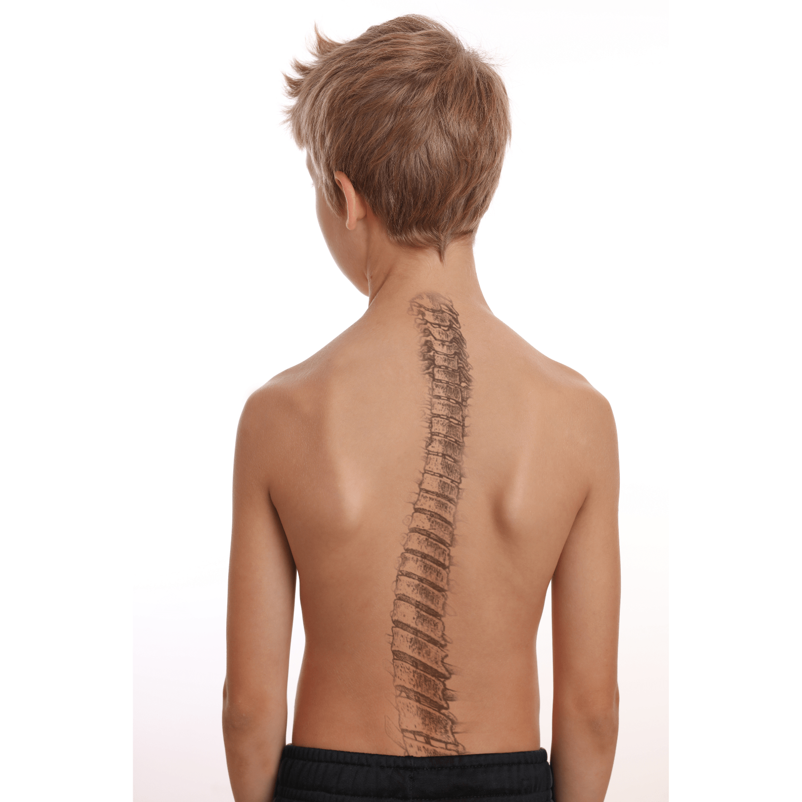 Sciatica